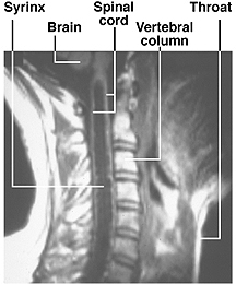 [PHOTO: MRI OF A POST-TRAUMATIC SYRINX]